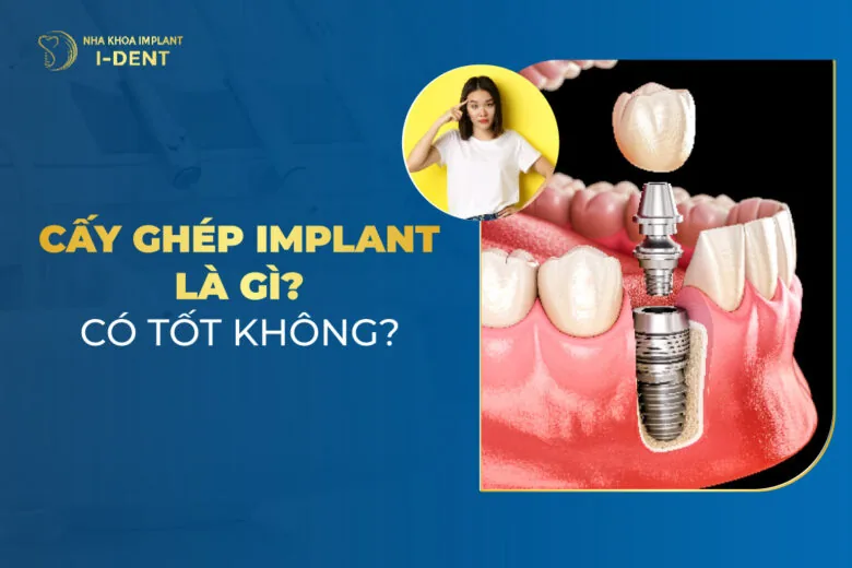 cấy ghép implant