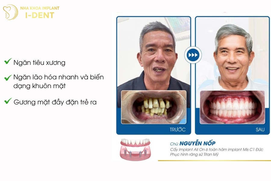 trồng implant là sao