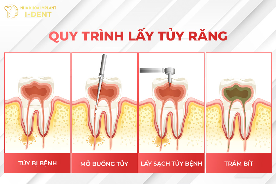 Qúa trình lấy tủy răng