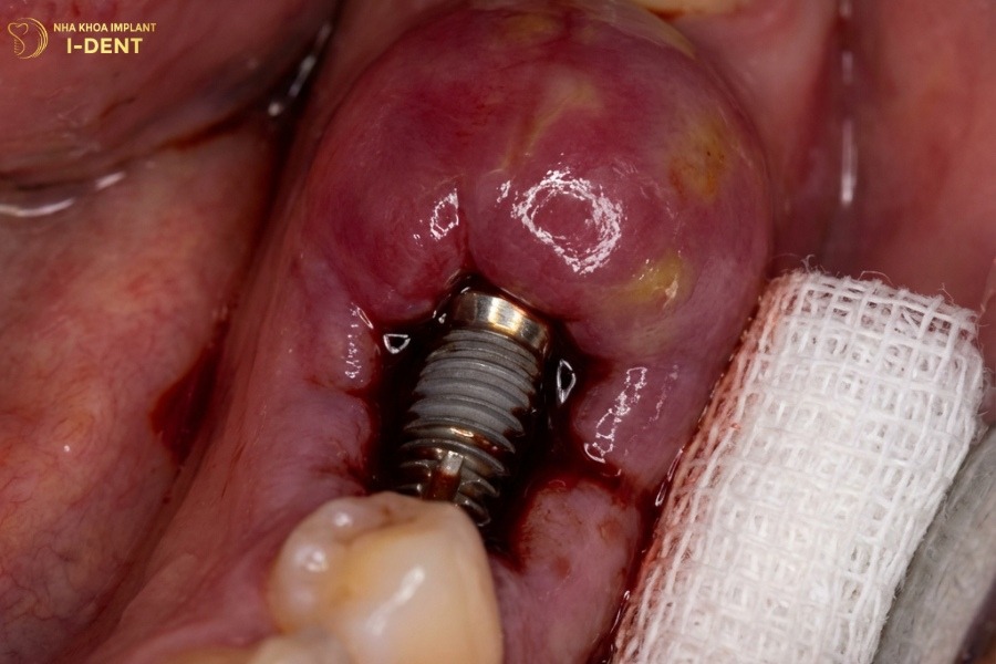 hậu quả của việc cắm trụ implant
