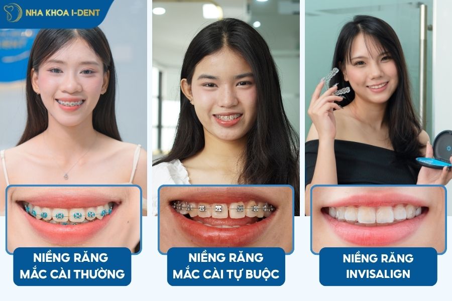 niềng răng mấy năm