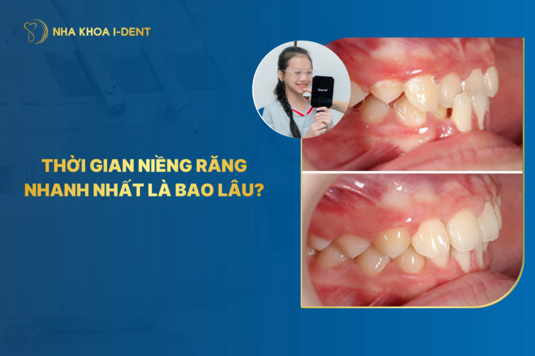 Thời Gian Niềng Răng Nhanh Nhất Mất Bao Lâu?
