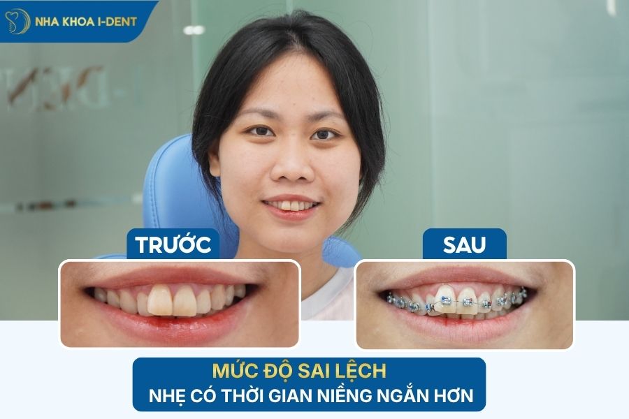 niềng răng mất bao nhiêu thời gian