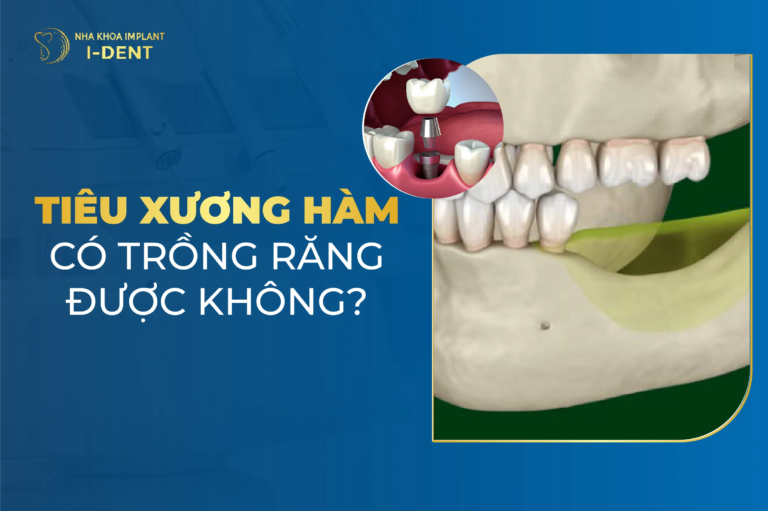 tiêu xương hàm có trồng răng được không