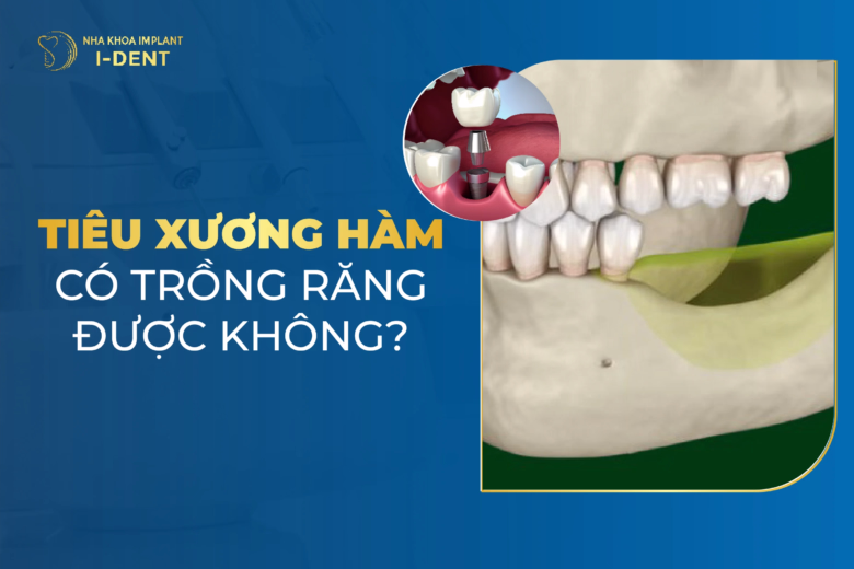 tiêu xương hàm có trồng răng được không