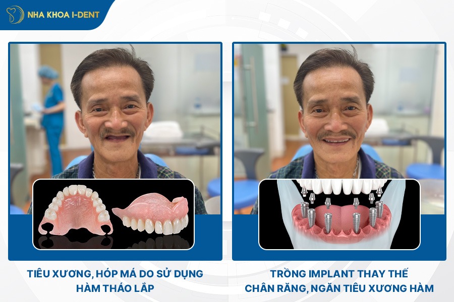 tiêu xương răng là gì