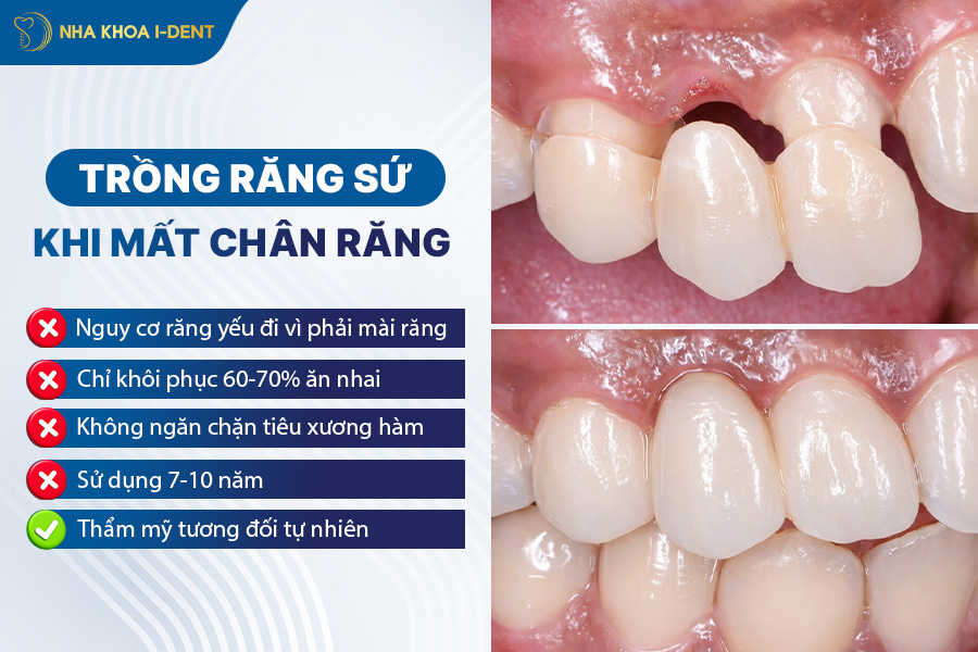 bắc cầu răng sứ