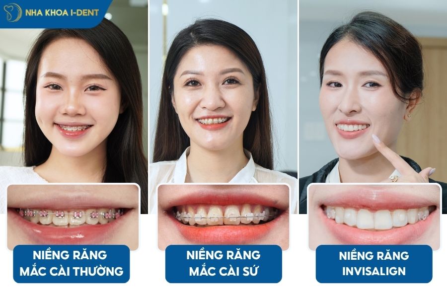 các trường hợp cần niềng răng