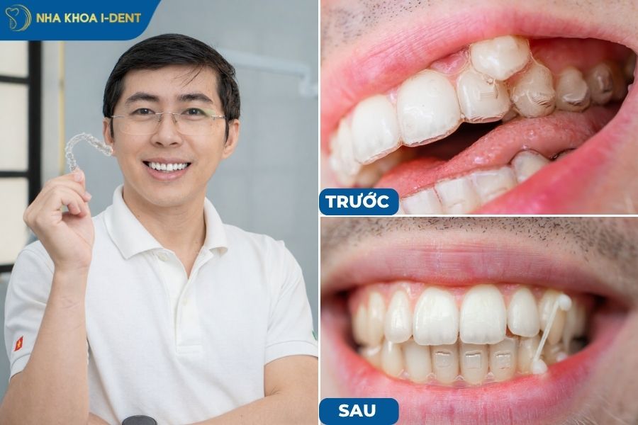khí cụ khay niềng trong suốt
