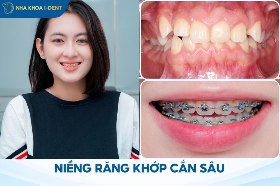 những trường hợp nên niềng răng
