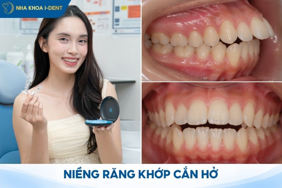 răng như nào thì nên niềng