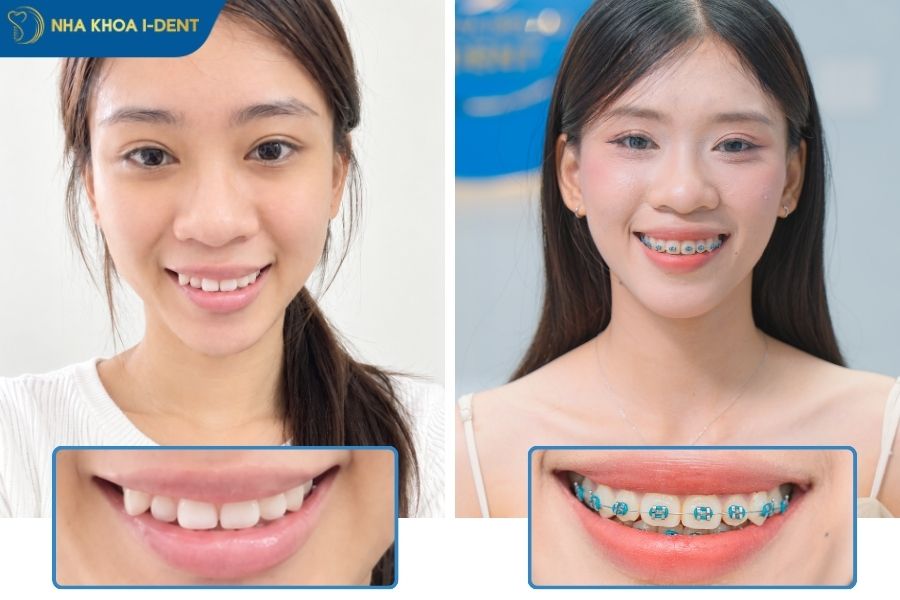 răng như thế nào thì nên niềng