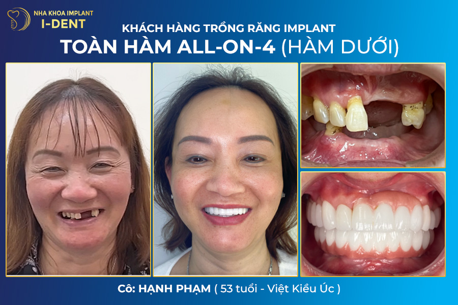 bảng giá cấy ghép răng implant