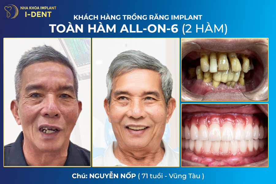 giá răng implant