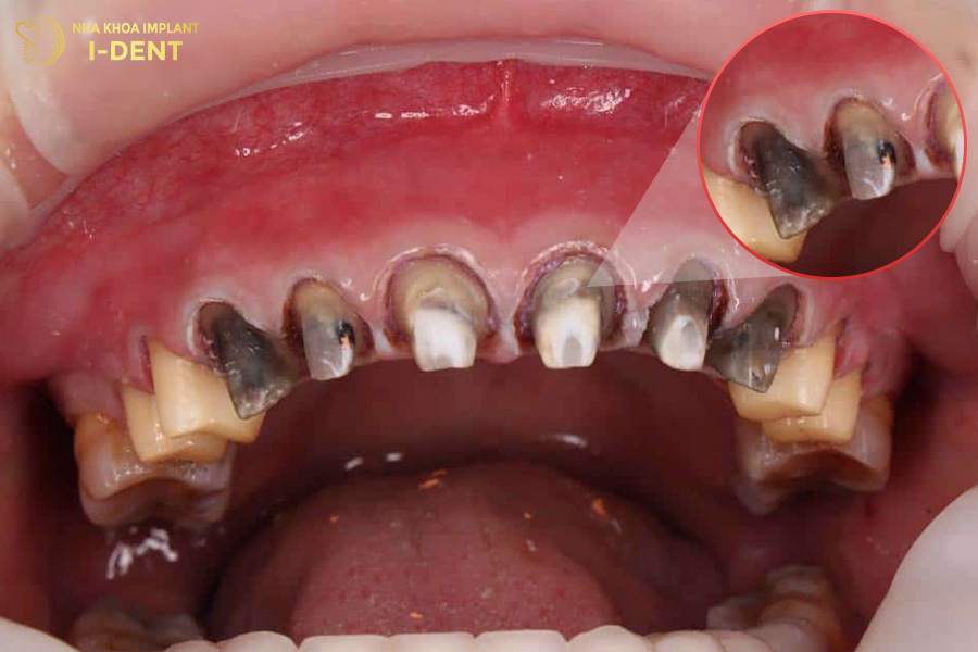 Hỏng răng gốc khi bọc răng sứ