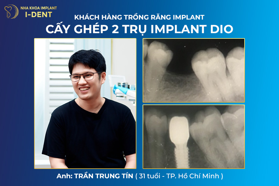 implant giá