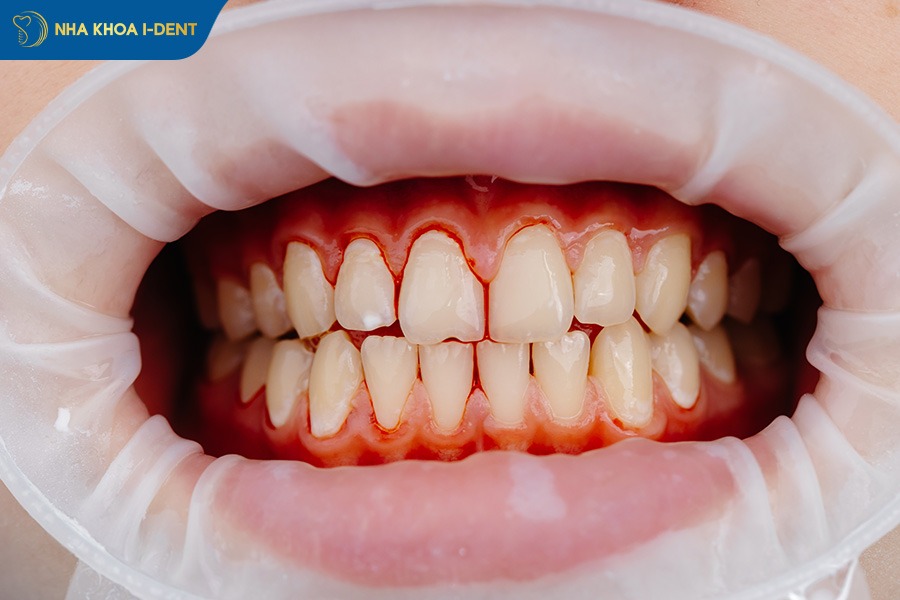 răng bọc sứ bị đau