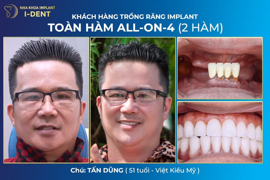 giá cấy implant