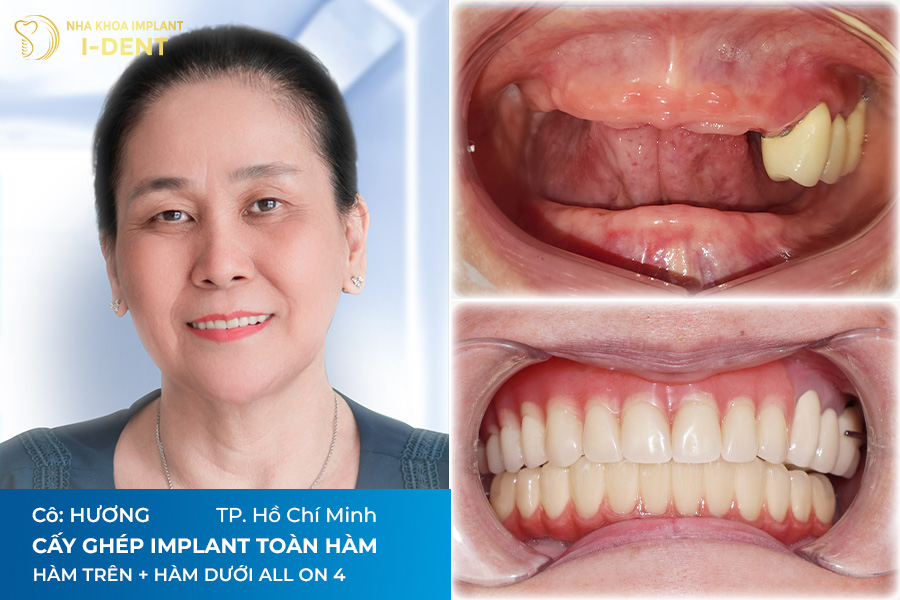 cấy ghép implant giá bao nhiêu