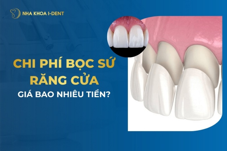 Chi Phí Bọc Răng Sứ 2 Răng Cửa Giá Bao Nhiêu Tiền?