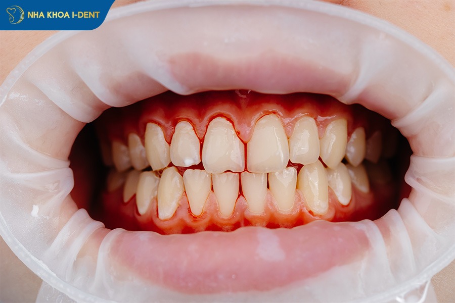 lắp răng sứ có đau ko