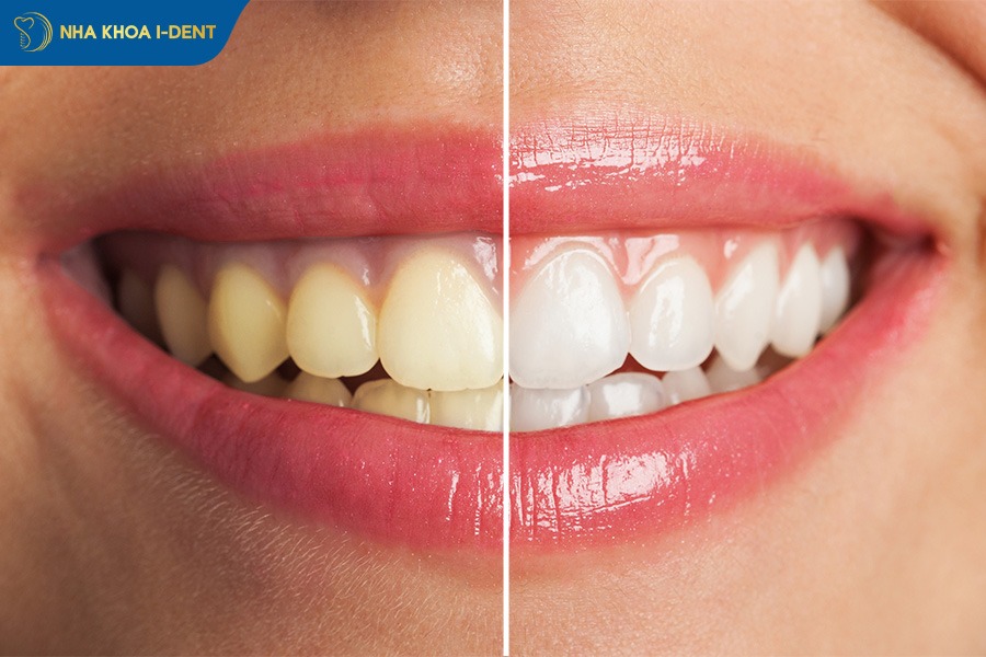 bọc răng sứ có đau không