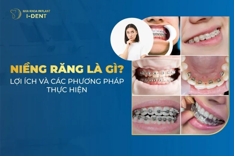 Niềng Răng: Lợi Ích, Các loại Và Quy Trình Thực Hiện