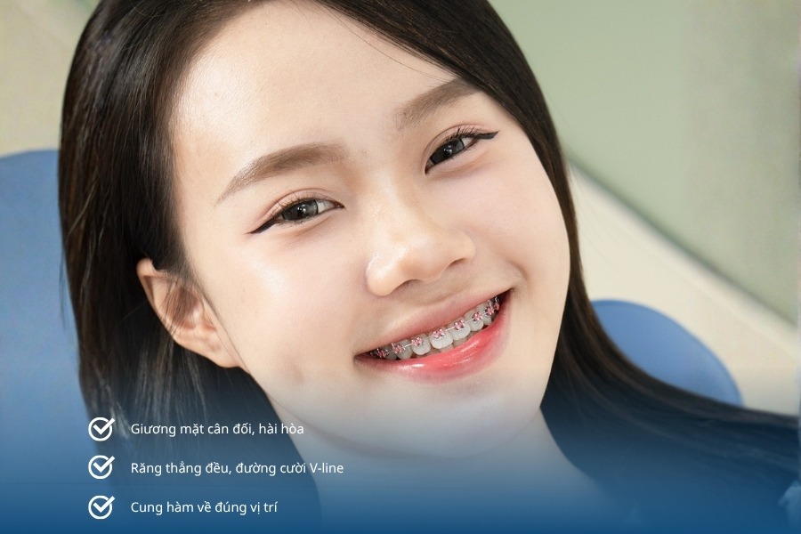 niềng răng để làm gì