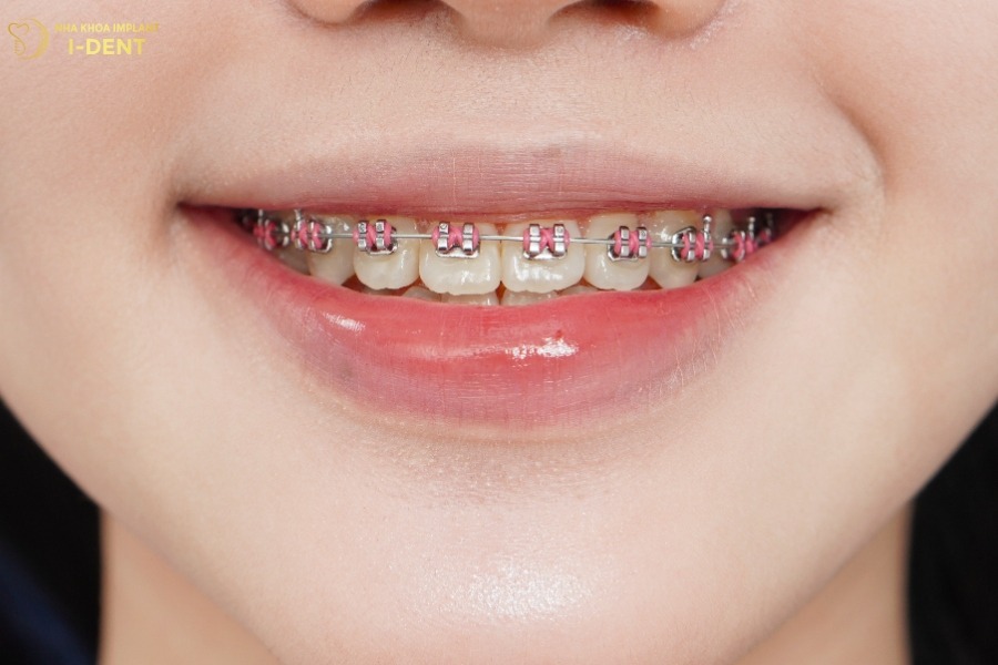 niềng răng là gì