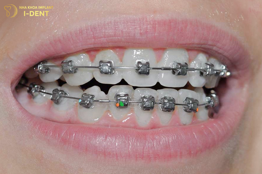 Phương pháp niềng răng thẩm mỹ