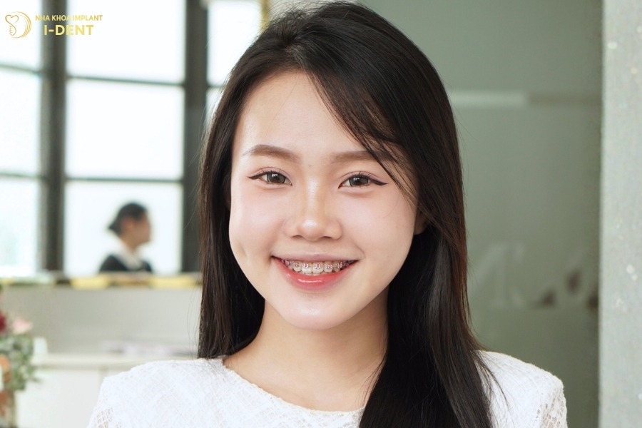 niềng răng như thế nào