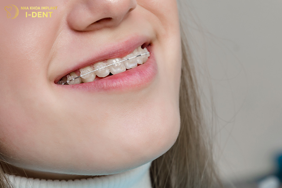 Niềng răng mắc cài sứ