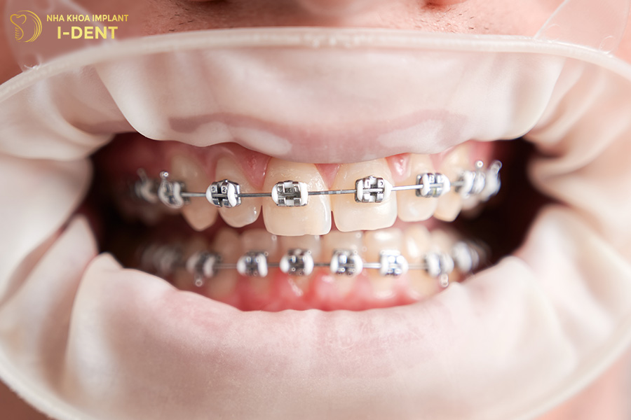 Niềng răng mắc cài tự buộc