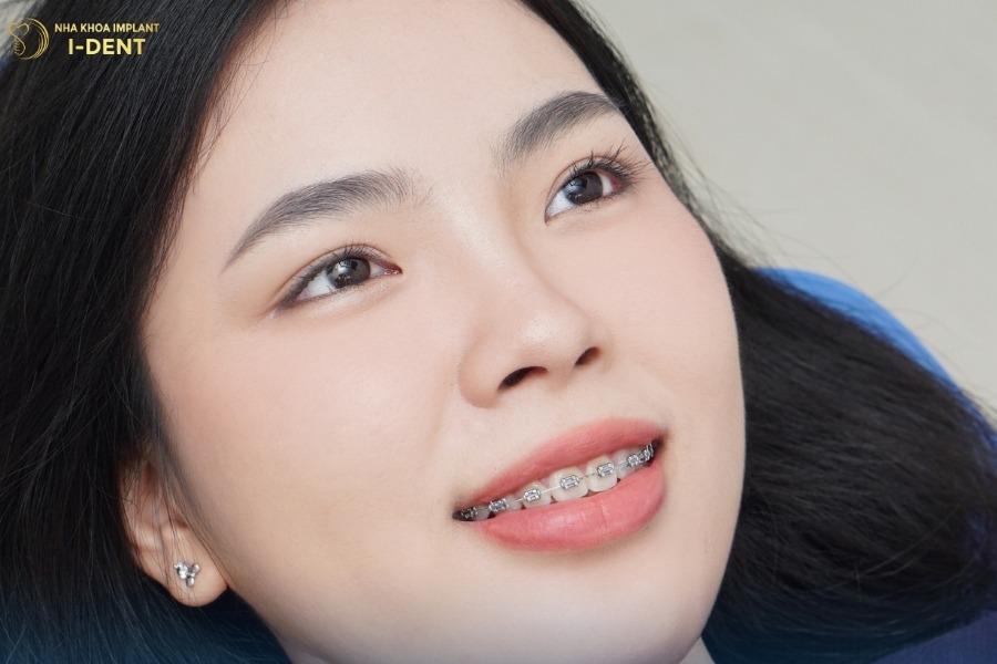 tìm hiểu về niềng răng