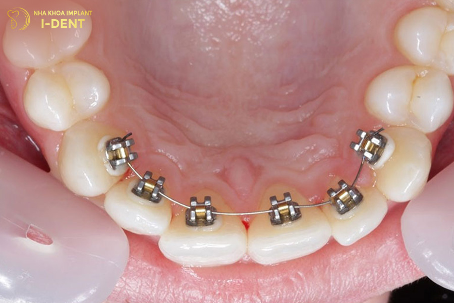 Niềng răng mắc cài mặt trong