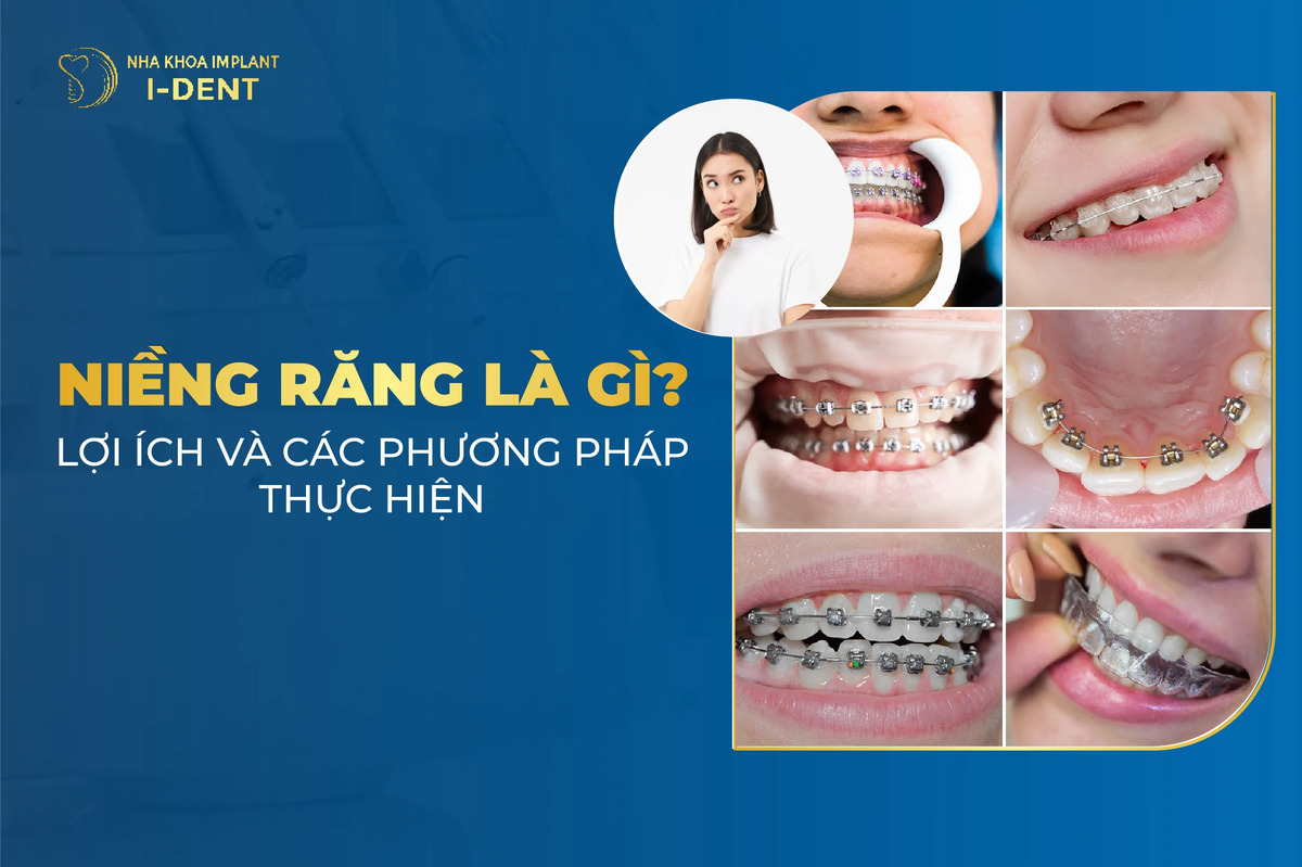 Niềng Răng Là Gì? Lợi Ích Và Các Phương Pháp Thực Hiện