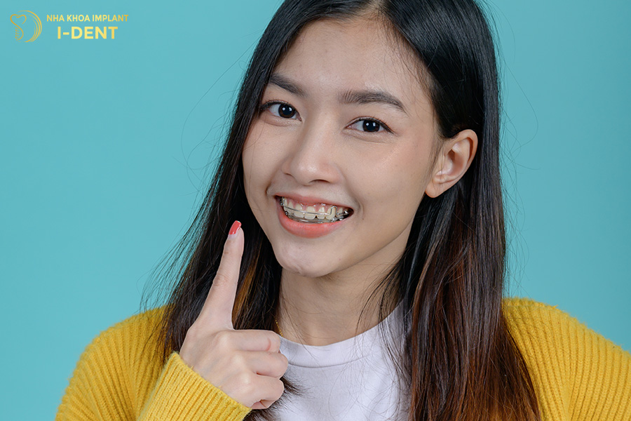 Thời gian niềng răng với người trưởng thành