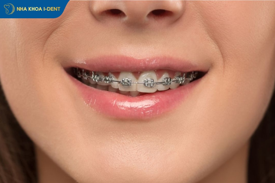 chi phí niềng răng 1 hàm