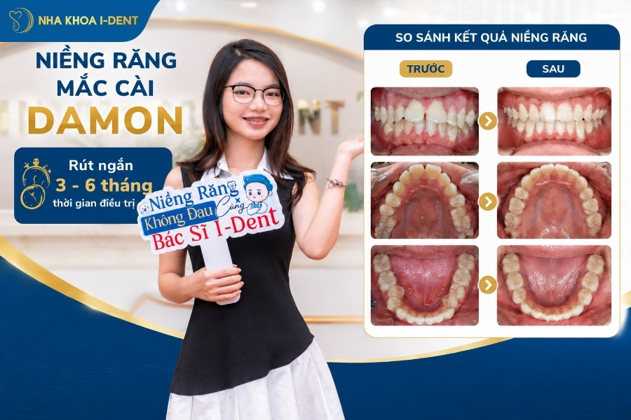 Niềng răng 1 hàm mất khoảng 12 - 24 tháng tùy vào mức độ lệch lạc của răng.