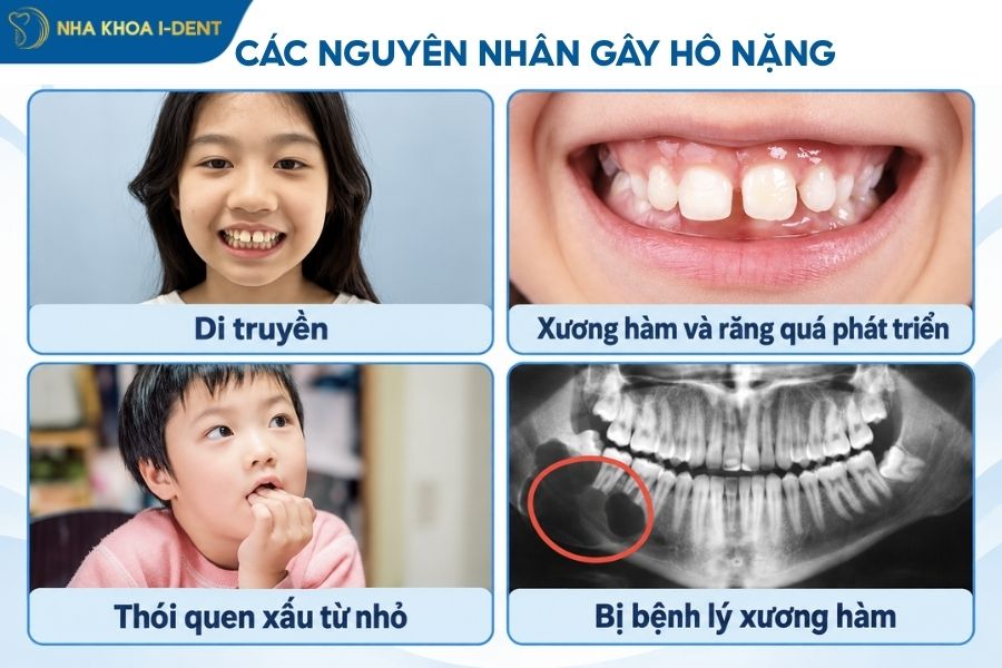 nguyên nhân gây hô nặng