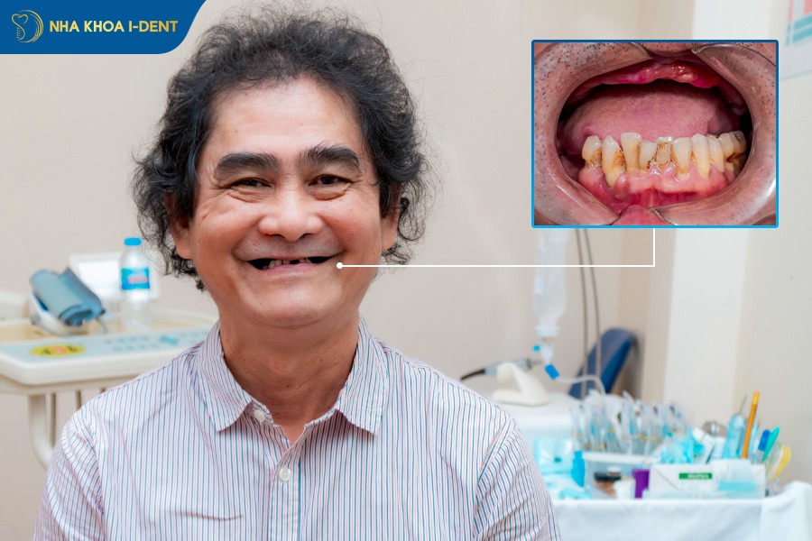 nhổ răng cấm không trồng lại có sao không