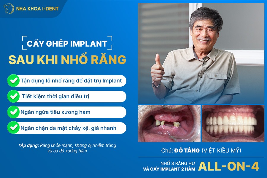 nhổ răng cửa bao lâu thì trồng lại được