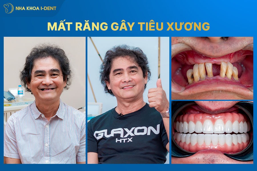 nhổ răng không trồng lại có sao không