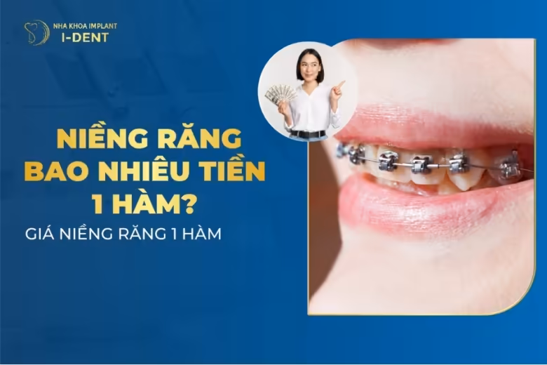 niềng răng bao nhiêu tiền 1 hàm