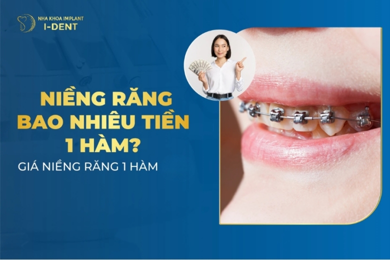 Niềng Răng Bao Nhiêu Tiền 1 Hàm? Bảng Giá 2026