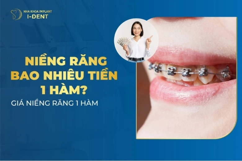 niềng răng bao nhiêu tiền 1 hàm