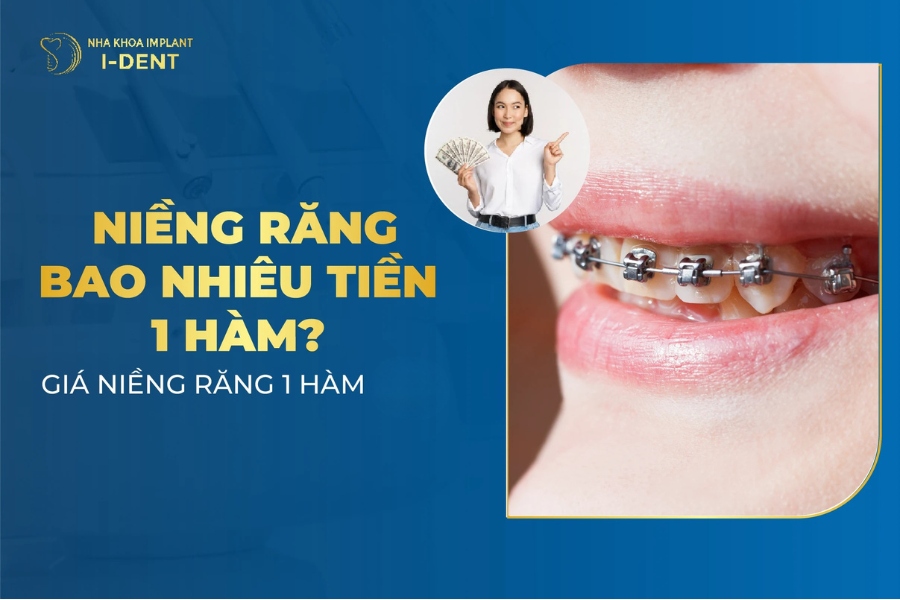 Niềng Răng Bao Nhiêu Tiền 1 Hàm? Bảng Giá 2026