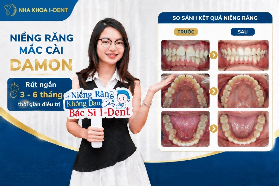 Niềng răng 1 hàm mất khoảng 12 - 24 tháng tùy vào mức độ lệch lạc của răng.
