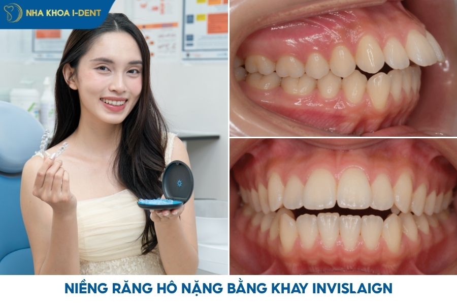niềng răng hô nặng bằng khay trong suốt
