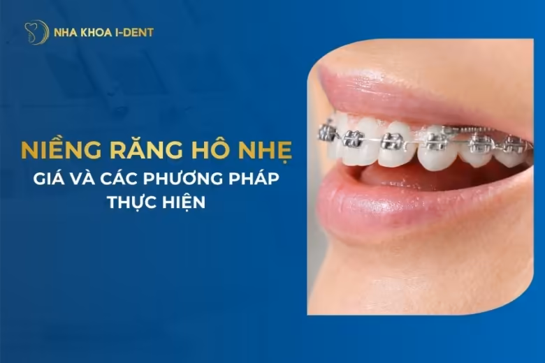 niềng răng hô nhẹ